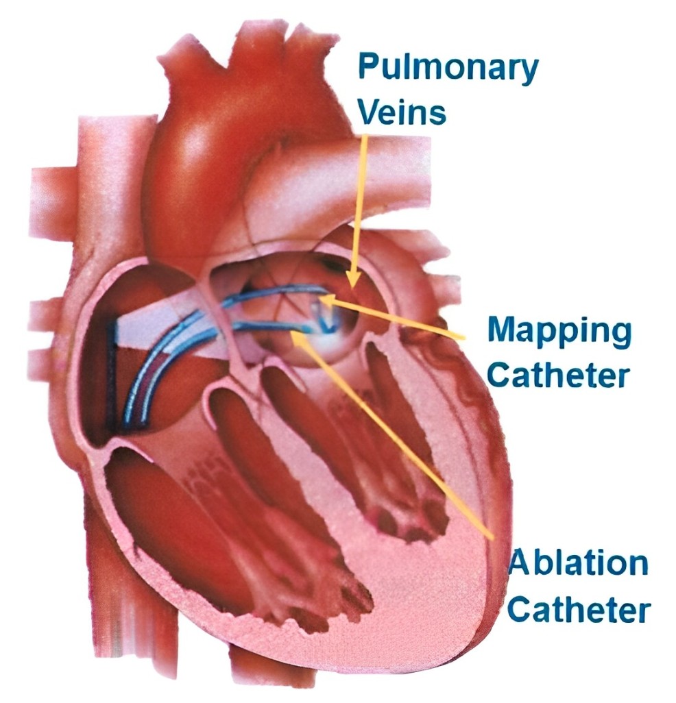 Pulmonary Vein Isolation Pensinsula Cardiology Group Pulmonary Vein Isolation Pensinsula Cardiology Group